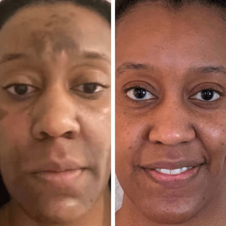 HYPERPIGMENTATION
